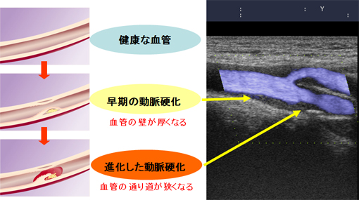頸動脈エコー検査